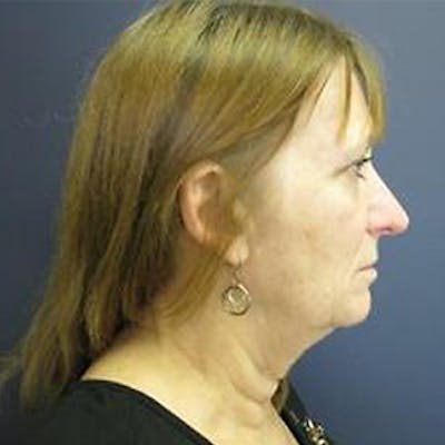 Neck Lift Before & After Gallery - Patient 825223 - Image 1