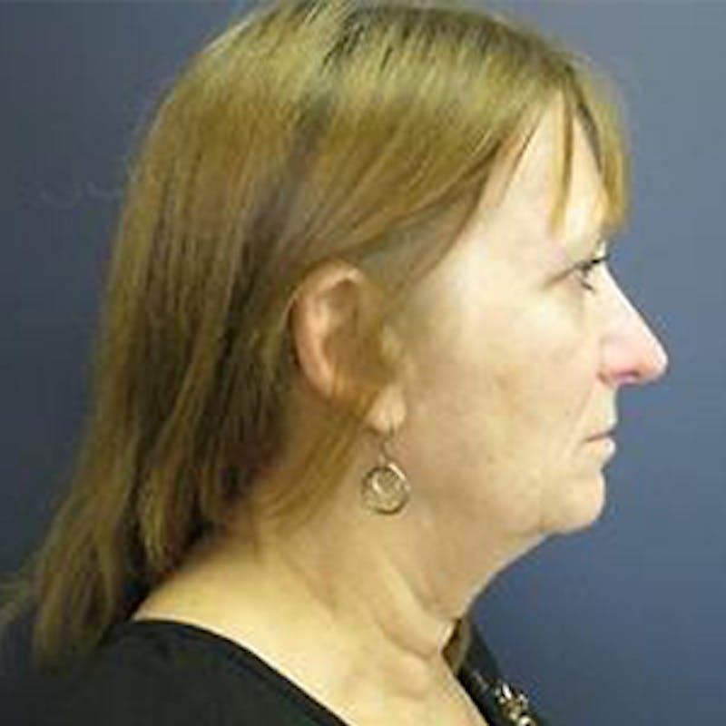 Neck Lift Before & After Gallery - Patient 825223 - Image 1