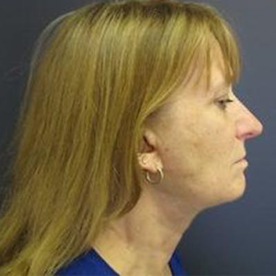 Neck Lift Before & After Gallery - Patient 825223 - Image 2