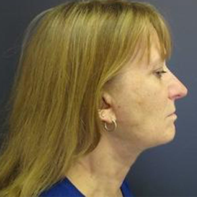Neck Lift Before & After Gallery - Patient 825223 - Image 2
