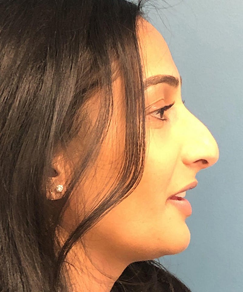 Rhinoplasty Before & After Gallery - Patient 263720 - Image 1