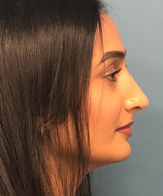 Rhinoplasty Before & After Gallery - Patient 263720 - Image 2