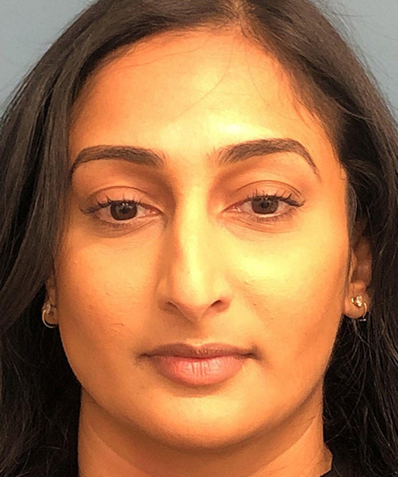 Rhinoplasty Before & After Gallery - Patient 263720 - Image 3