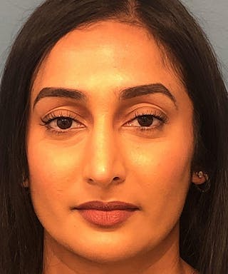 Rhinoplasty Before & After Gallery - Patient 263720 - Image 4