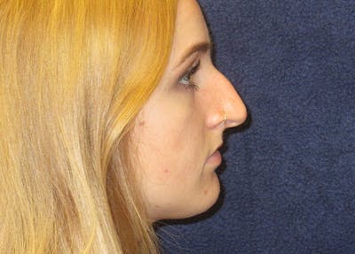 Rhinoplasty Before & After Gallery - Patient 173940 - Image 1
