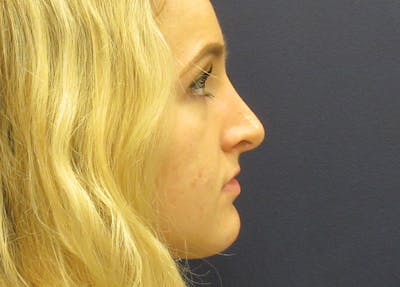 Rhinoplasty Before & After Gallery - Patient 173940 - Image 2