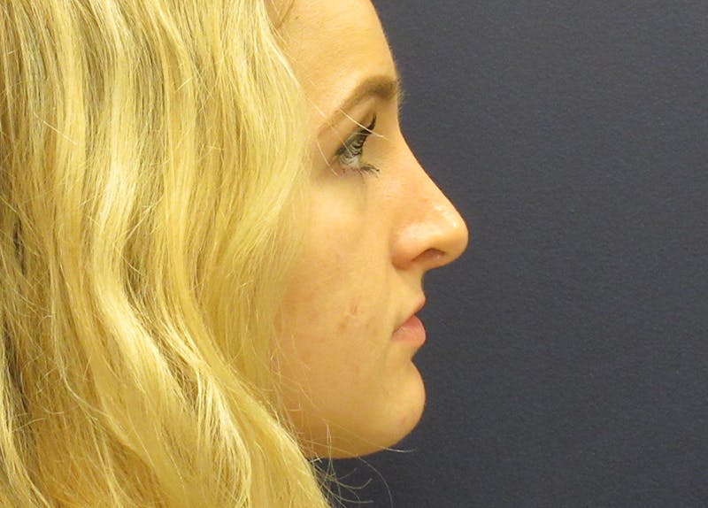 Rhinoplasty Before & After Gallery - Patient 173940 - Image 2