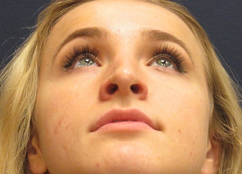 Rhinoplasty Before & After Gallery - Patient 173940 - Image 4