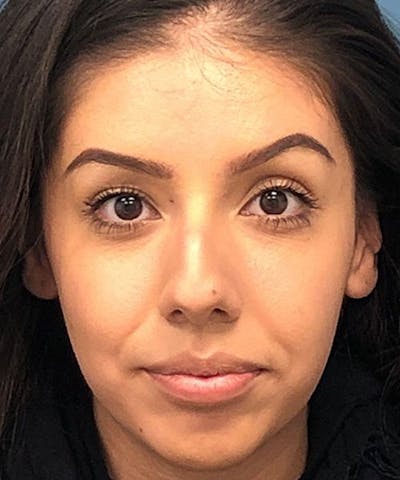 Rhinoplasty Before & After Gallery - Patient 346664 - Image 1