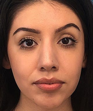 Rhinoplasty Before & After Gallery - Patient 346664 - Image 2
