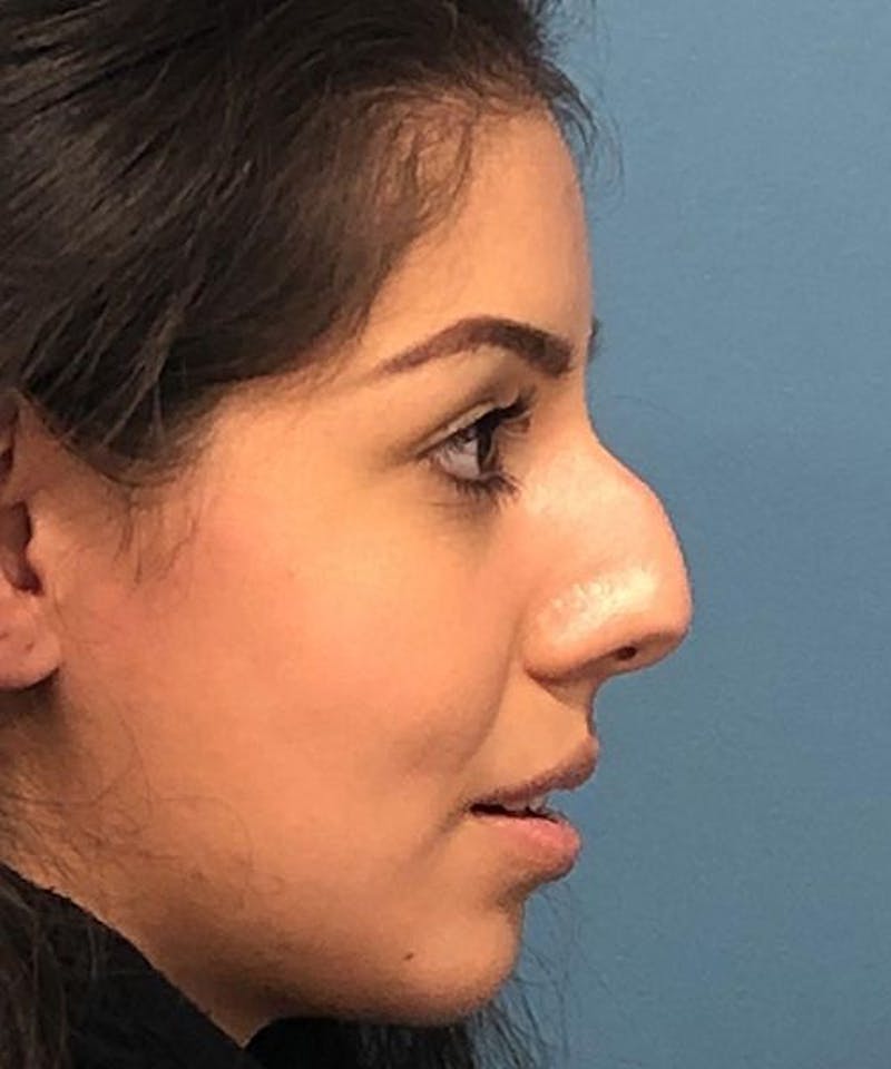 Rhinoplasty Before & After Gallery - Patient 346664 - Image 3
