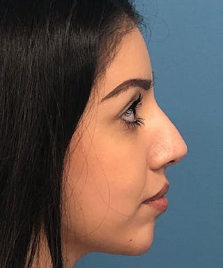 Rhinoplasty Before & After Gallery - Patient 346664 - Image 4
