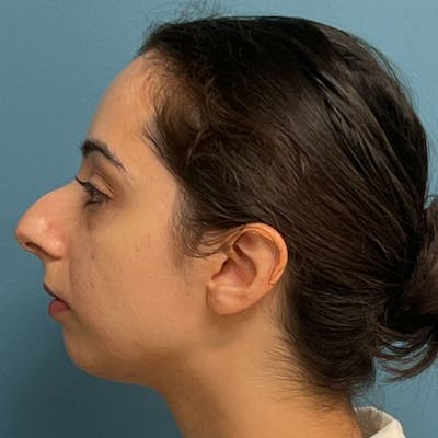 Rhinoplasty Before & After Gallery - Patient 103465 - Image 1
