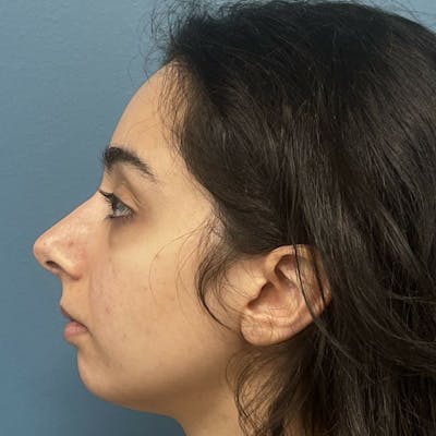 Rhinoplasty Before & After Gallery - Patient 103465 - Image 2