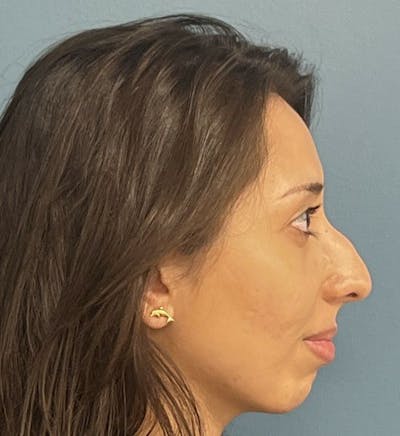 Rhinoplasty Before & After Gallery - Patient 121284 - Image 1
