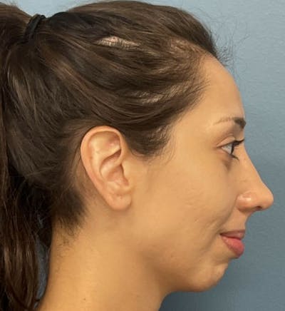 Rhinoplasty Before & After Gallery - Patient 121284 - Image 2