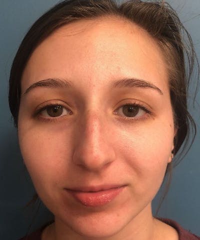 Rhinoplasty Before & After Gallery - Patient 471423 - Image 1