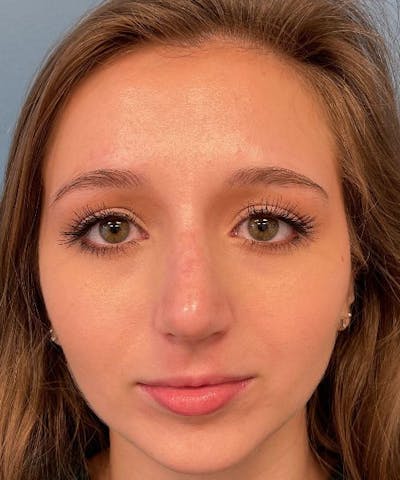 Rhinoplasty Before & After Gallery - Patient 471423 - Image 2