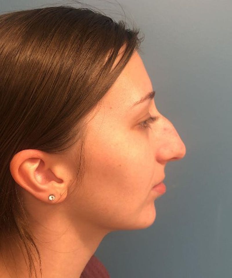 Rhinoplasty Before & After Gallery - Patient 471423 - Image 3