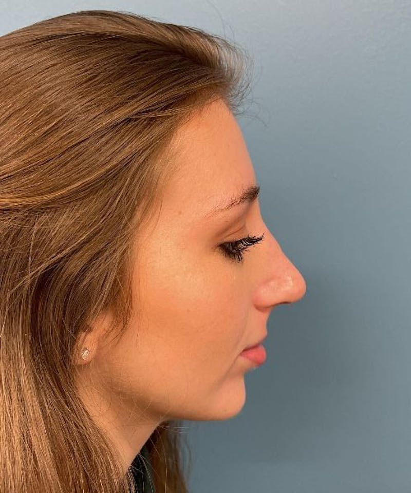 Rhinoplasty Before & After Gallery - Patient 471423 - Image 4