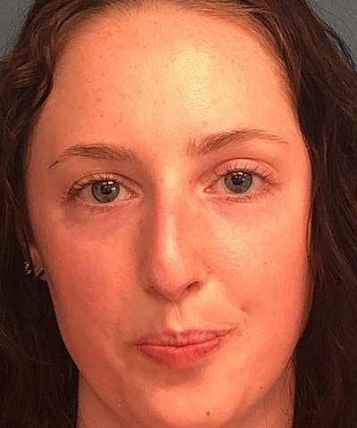 Rhinoplasty Before & After Gallery - Patient 394543 - Image 1