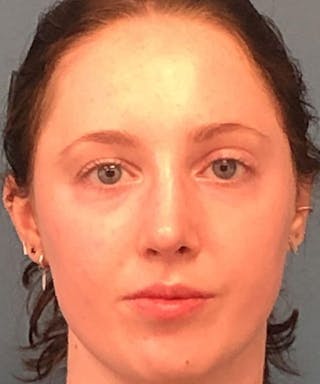 Rhinoplasty Before & After Gallery - Patient 394543 - Image 2