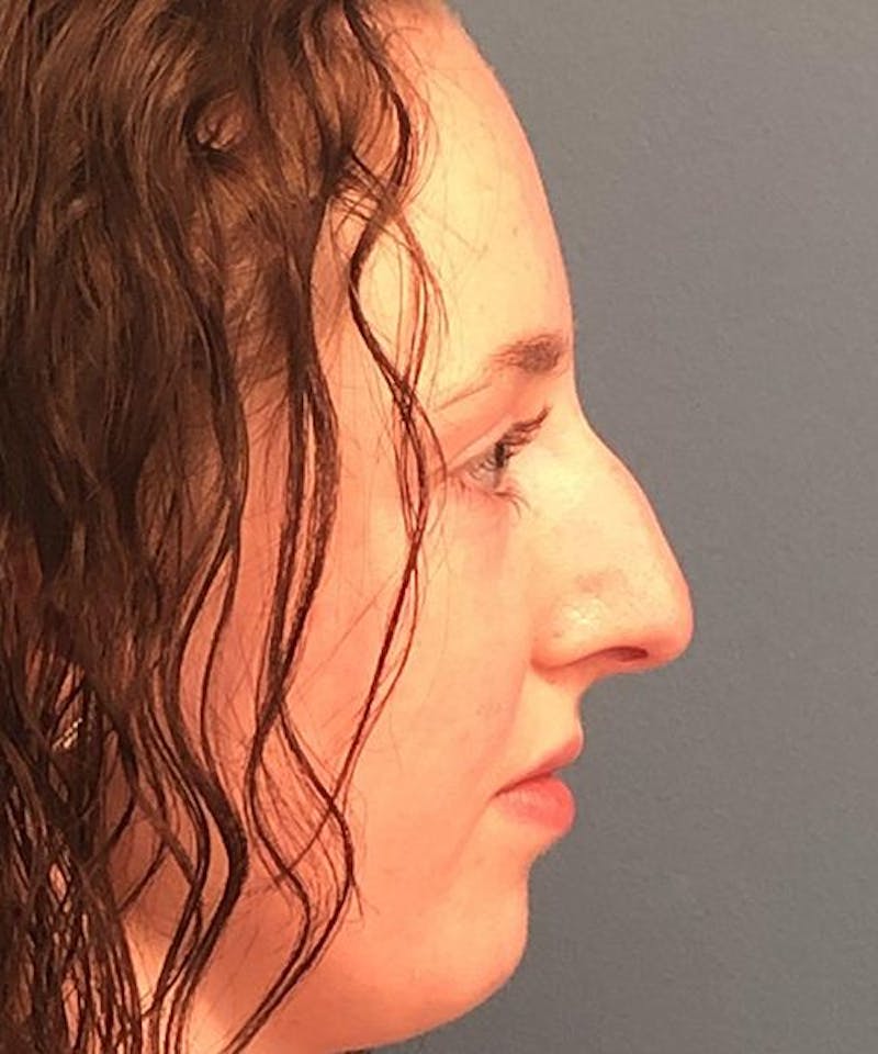 Rhinoplasty Before & After Gallery - Patient 394543 - Image 3