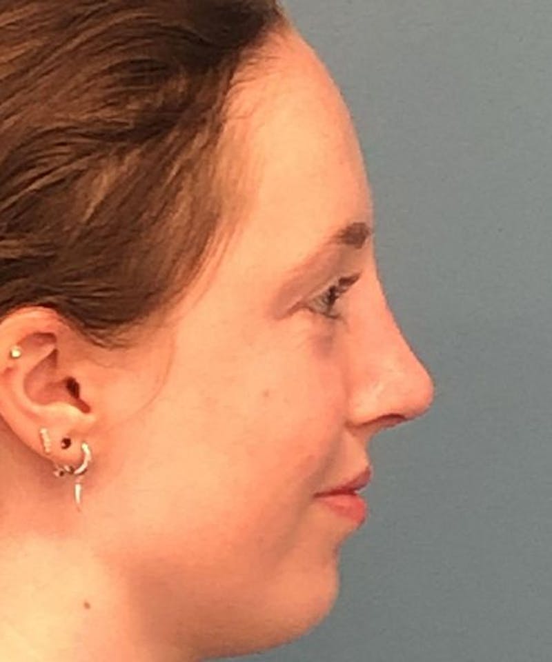 Rhinoplasty Before & After Gallery - Patient 394543 - Image 4