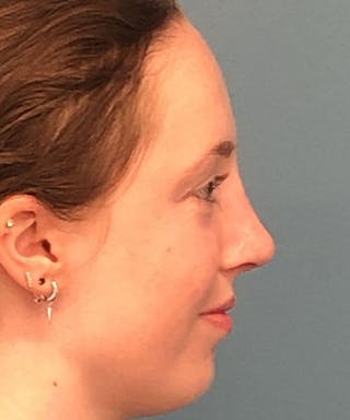 Rhinoplasty Before & After Gallery - Patient 394543 - Image 4