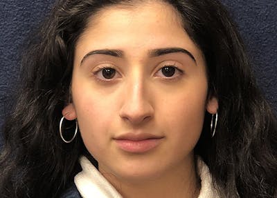 Rhinoplasty Before & After Gallery - Patient 206123 - Image 1