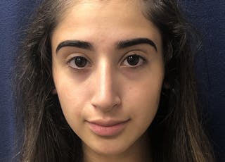 Rhinoplasty Before & After Gallery - Patient 206123 - Image 2