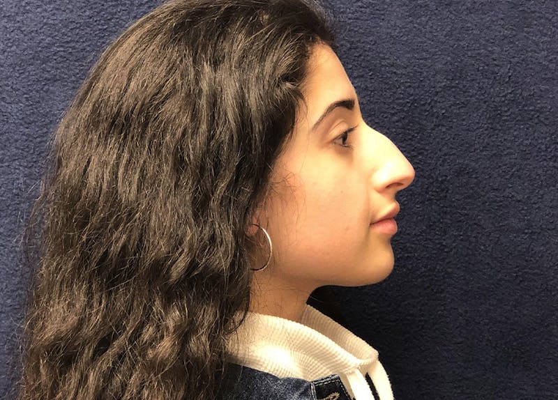 Rhinoplasty Before & After Gallery - Patient 206123 - Image 3