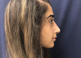 Rhinoplasty Before & After Gallery - Patient 206123 - Image 4