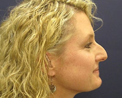 Rhinoplasty Before & After Gallery - Patient 269630 - Image 1