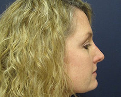 Rhinoplasty Before & After Gallery - Patient 269630 - Image 2