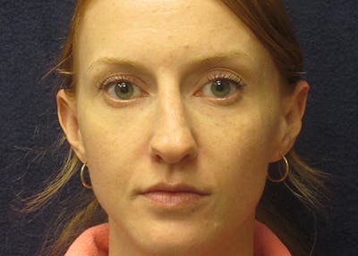 Rhinoplasty Before & After Gallery - Patient 572435 - Image 1