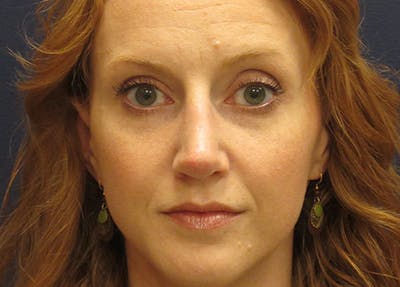 Rhinoplasty Before & After Gallery - Patient 572435 - Image 2