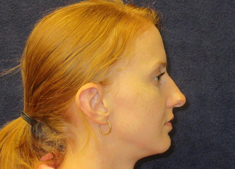 Rhinoplasty Before & After Gallery - Patient 572435 - Image 3