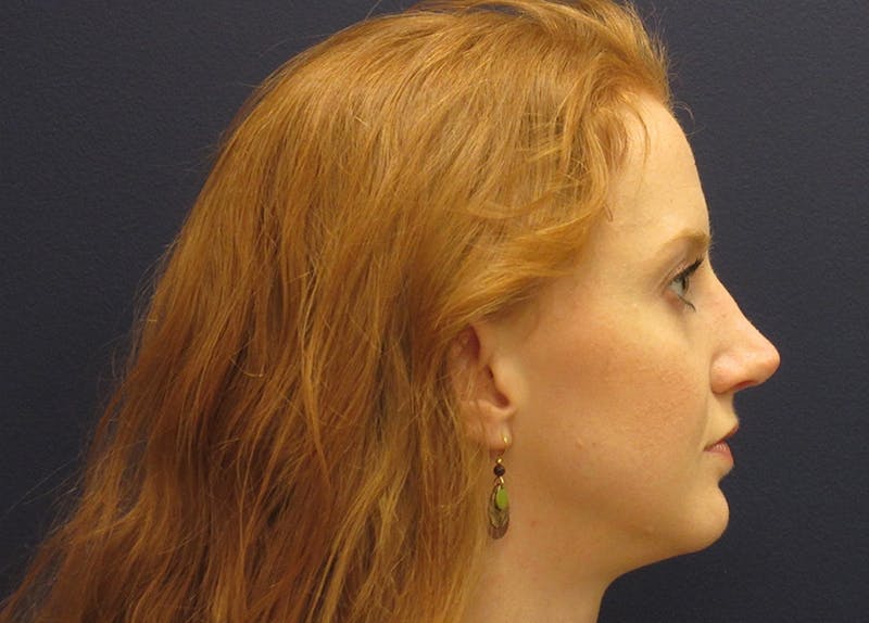 Rhinoplasty Before & After Gallery - Patient 572435 - Image 4