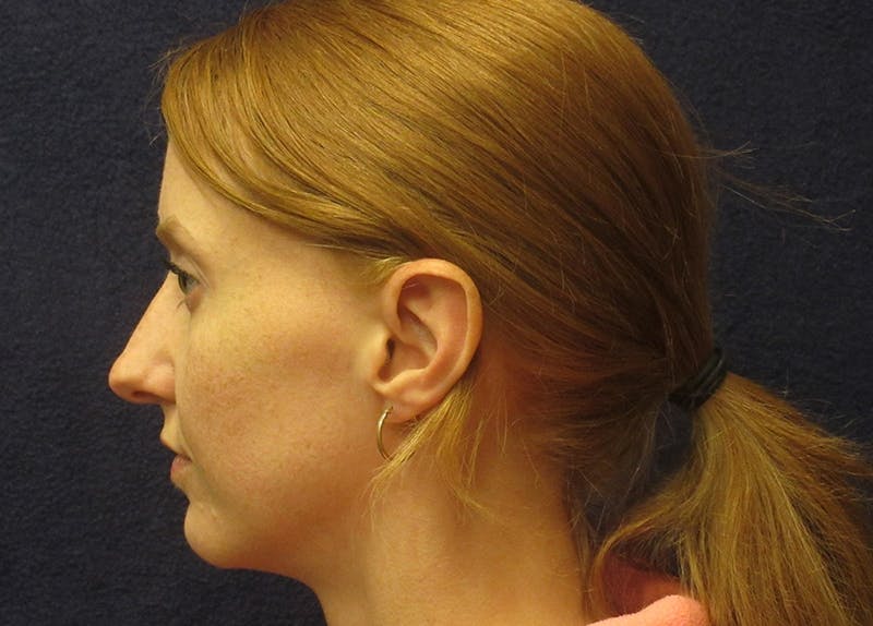 Rhinoplasty Before & After Gallery - Patient 572435 - Image 5