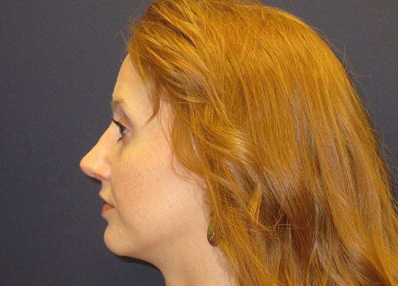 Rhinoplasty Before & After Gallery - Patient 572435 - Image 6