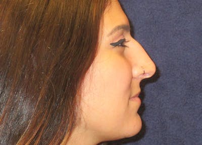 Rhinoplasty Before & After Gallery - Patient 185863 - Image 1