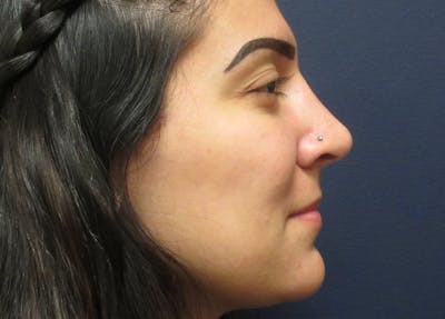 Rhinoplasty Before & After Gallery - Patient 185863 - Image 2