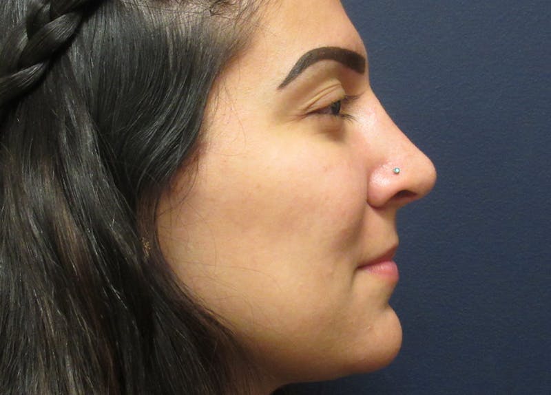Rhinoplasty Before & After Gallery - Patient 185863 - Image 2