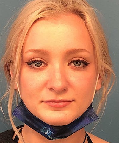 Rhinoplasty Before & After Gallery - Patient 107149 - Image 1