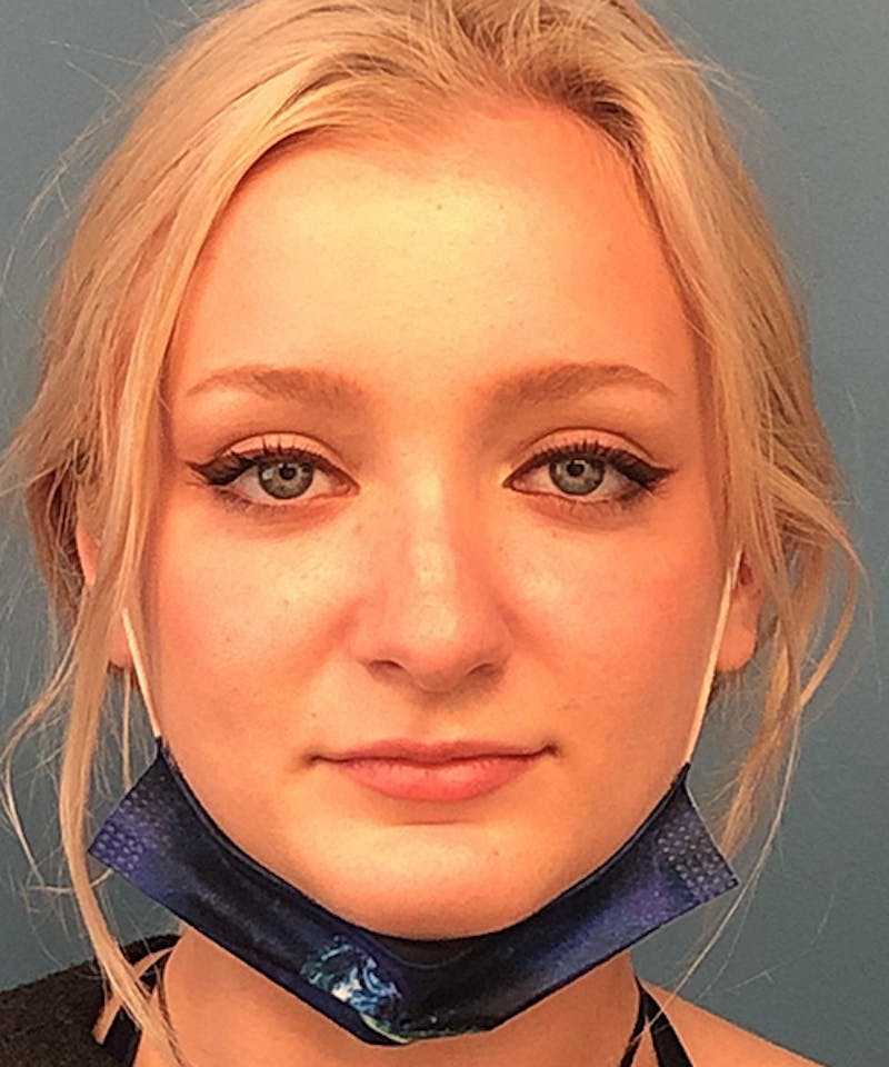 Rhinoplasty Before & After Gallery - Patient 107149 - Image 1