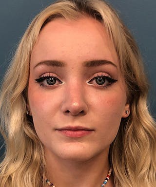 Rhinoplasty Before & After Gallery - Patient 107149 - Image 2
