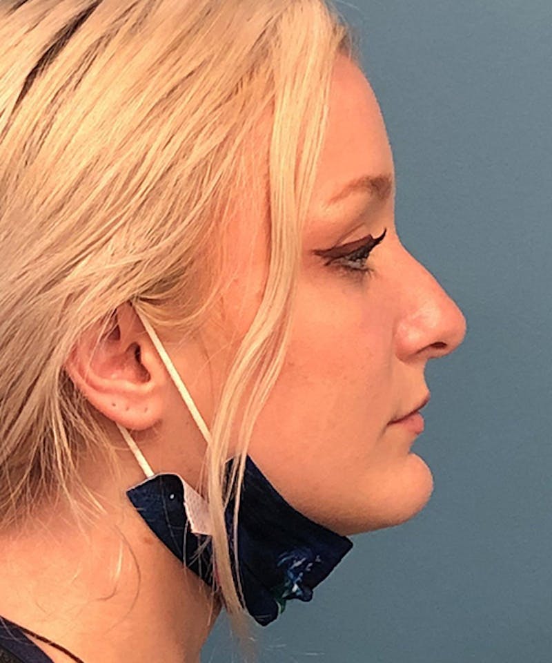 Rhinoplasty Before & After Gallery - Patient 107149 - Image 3
