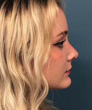 Rhinoplasty Before & After Gallery - Patient 107149 - Image 4