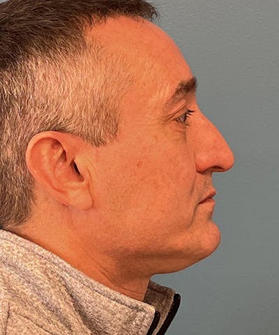 Rhinoplasty Before & After Gallery - Patient 154055 - Image 1